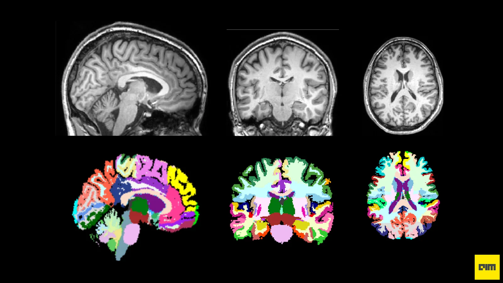 TorchIO - A PyTorch Library Using Patch-based Learning For Medical ...